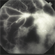 Ischemic Proliferative Diabetic retinopathy Ischemic Proliferative Diabetic retinopathy